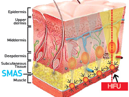 What is High Intensity Focused Ultrasound (HIFU)?
